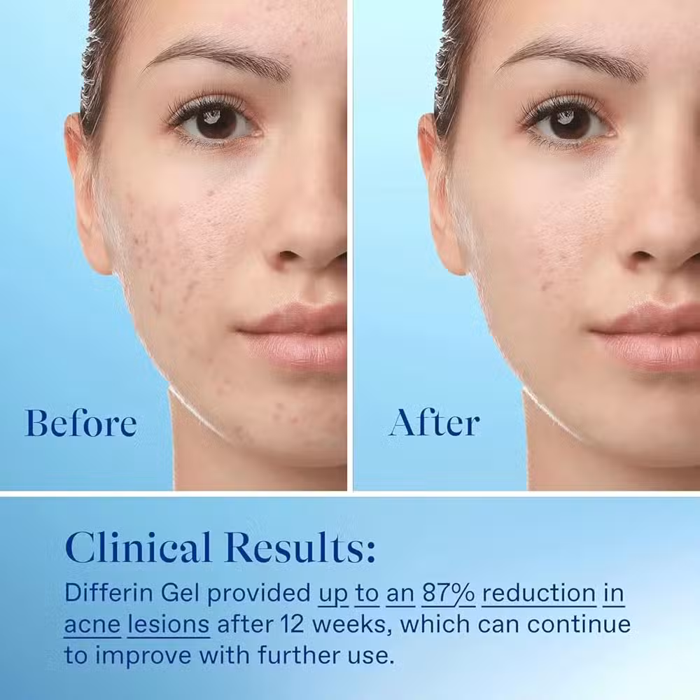 Differin Adapalene 0.1% Acne Treatment Gel New - Image 4