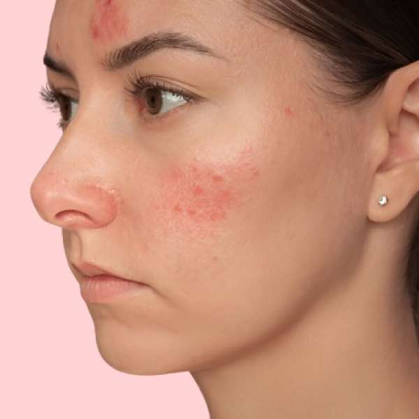 Acne