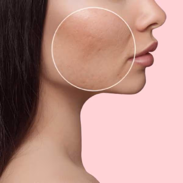 Pores